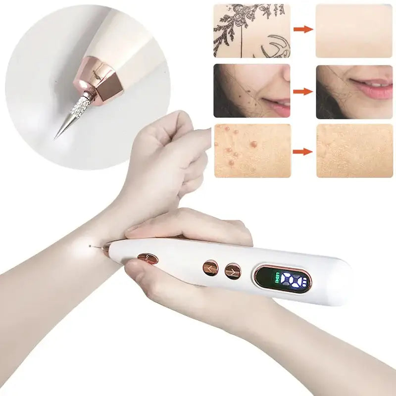 PLUMA LASER PLASMA™ ELIMINADOR DE MANCHAS Y VERRUGAS